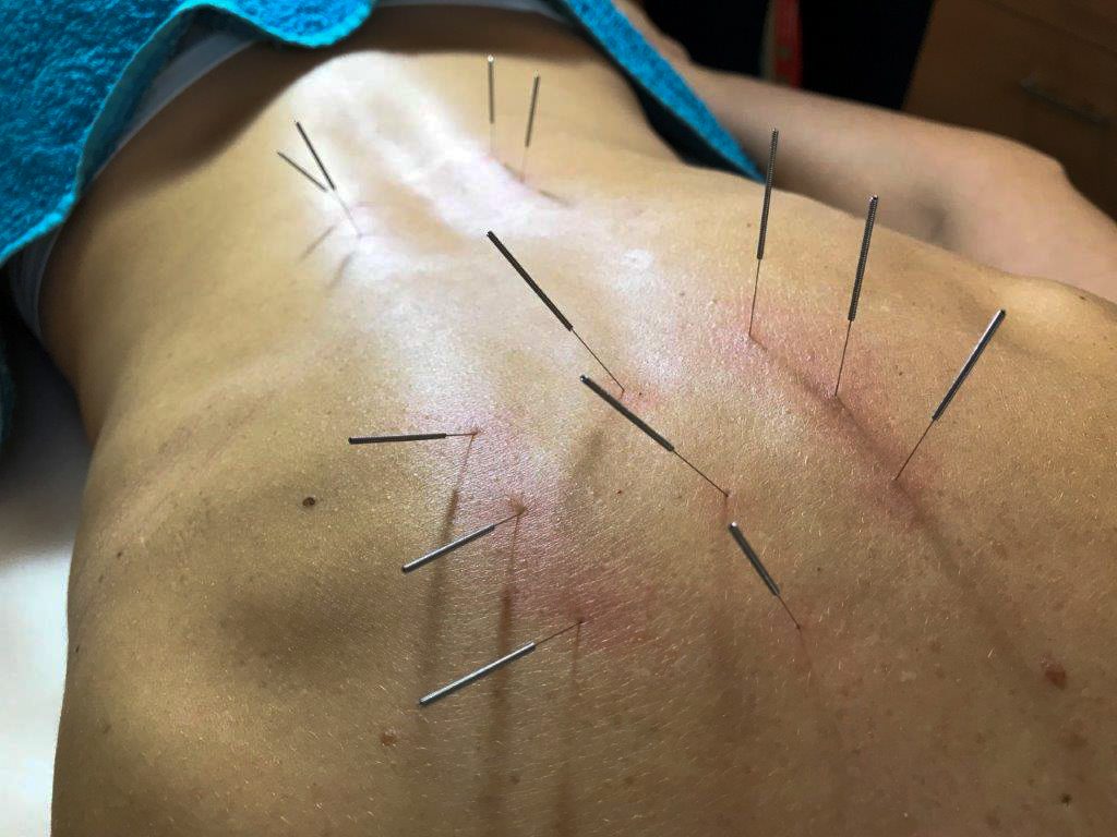 Akupunktura kezelés - Medical Healing Point